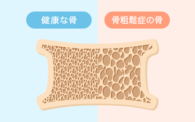 骨粗鬆症外来